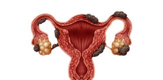 Endometriozis Nedir?