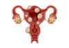 Fibroid