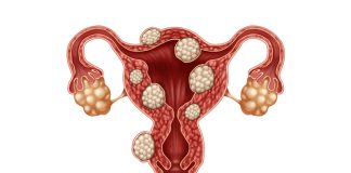 Fibroid Fibroid